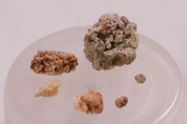 泌尿系结石怎么来的？这种情况更危险！